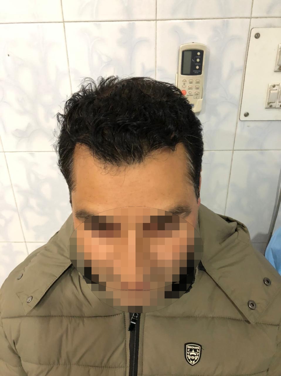 Hair Transplant and Skin Treatment