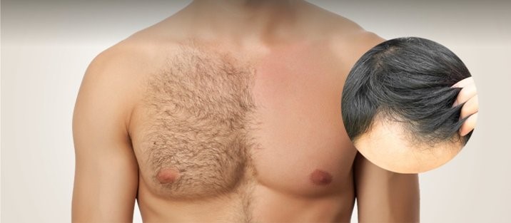 Body Hair Transplant(BHT)