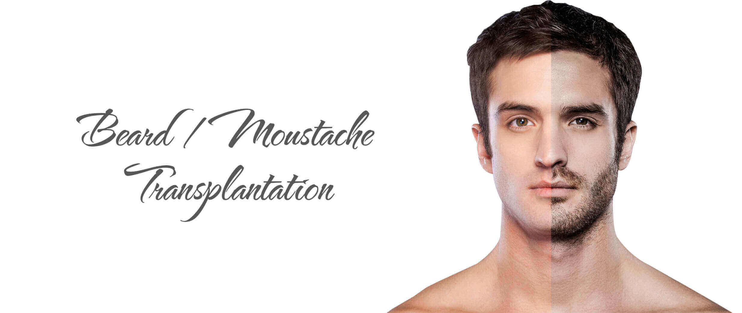 Beard/Moustache Transplantation
