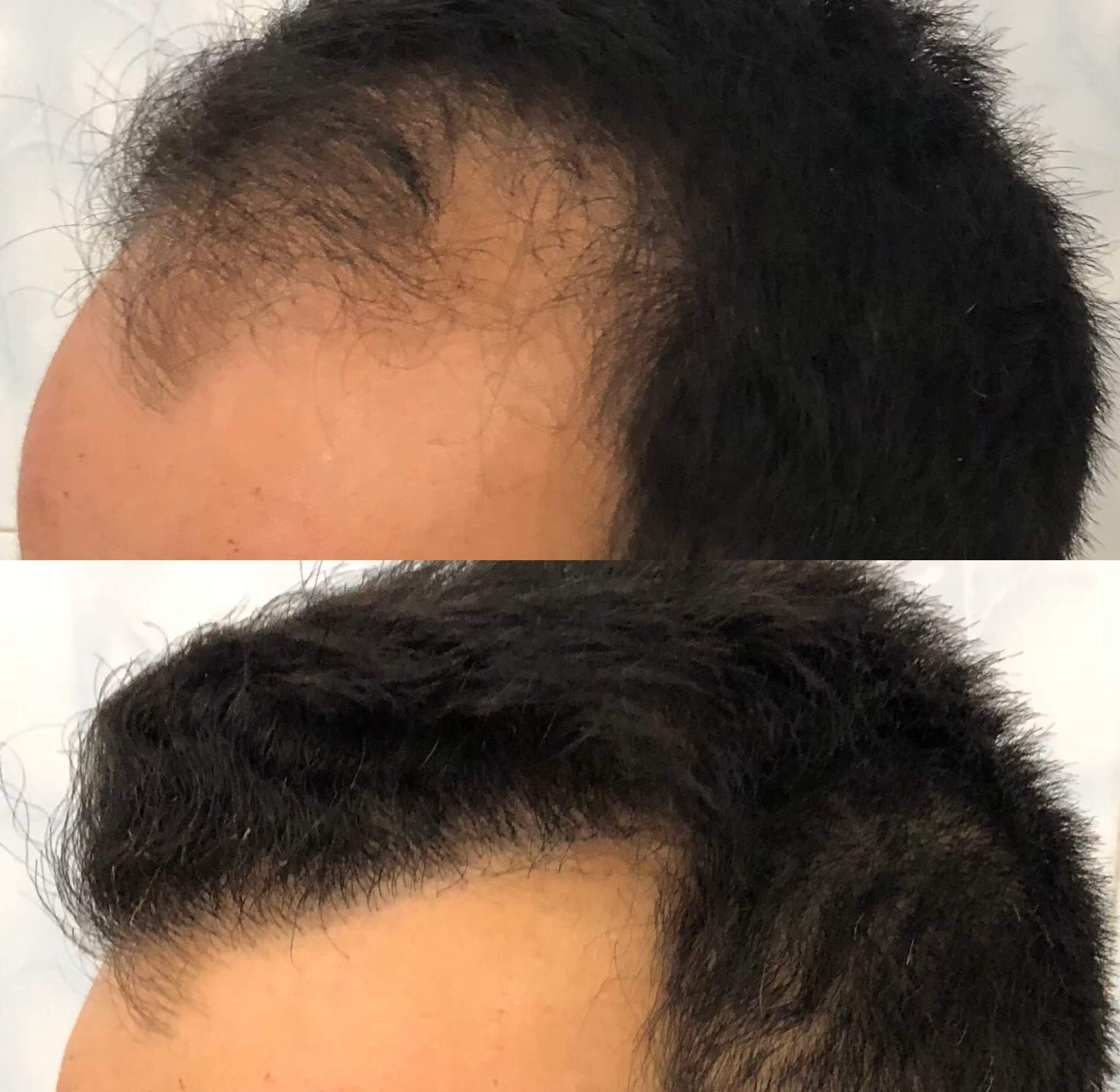 Failed Hair Transplant Repair